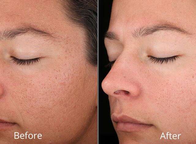 Chemical peel.docx-1