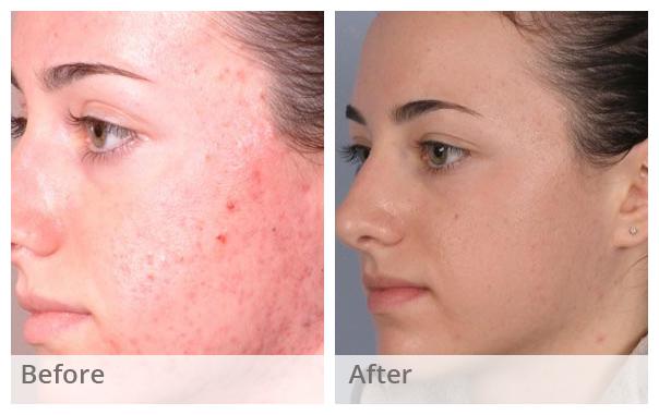 Chemical peel.docx-2