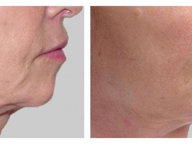 Facial skin tightening - 5.docx