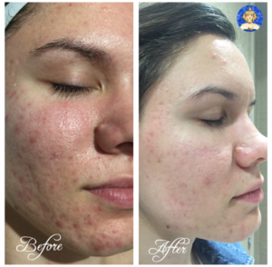 Micro-Acne before and after