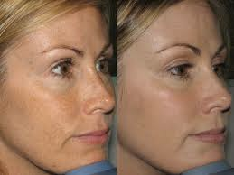 Photofacial before and after