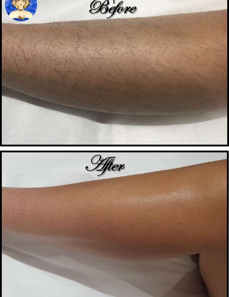 leg laser before and after